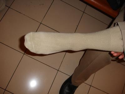 Mi tobillo hinchado